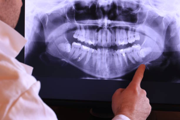 Best Emergency Wisdom Teeth Removal in Lake Lorraine, FL